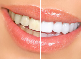 before and after teeth whitening