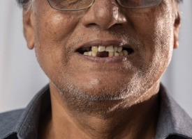 full and partial dentures