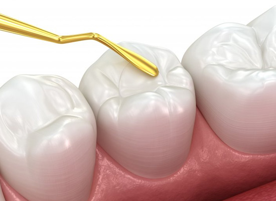 Digital image of a tooth-colored filling